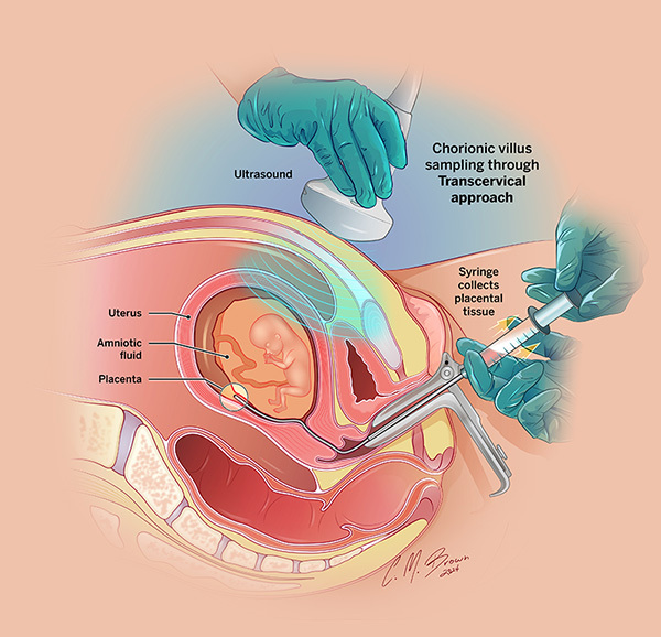 Transcervical-Chorionic-Villus-Sampling_v3