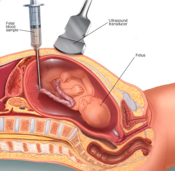 percutaneous-umbilical-blood-sampling